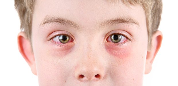 Criança com conjuntivite na Ser e Crescer - Serviços Clínicos.